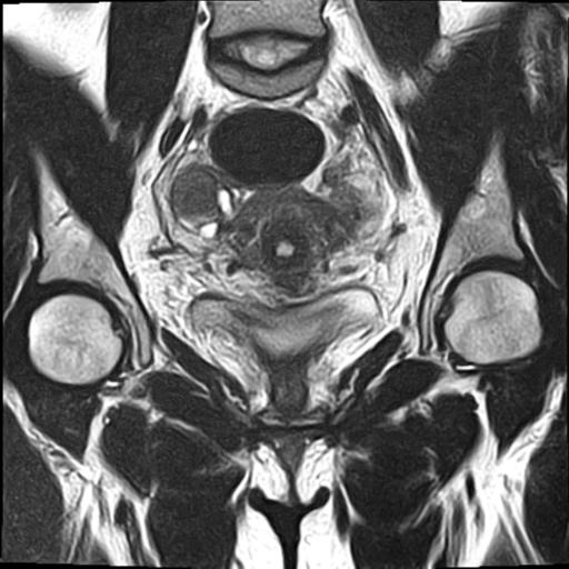 File:Bilateral ovarian endometriomas (Radiopaedia 87085-103347 Coronal T2 9).jpg