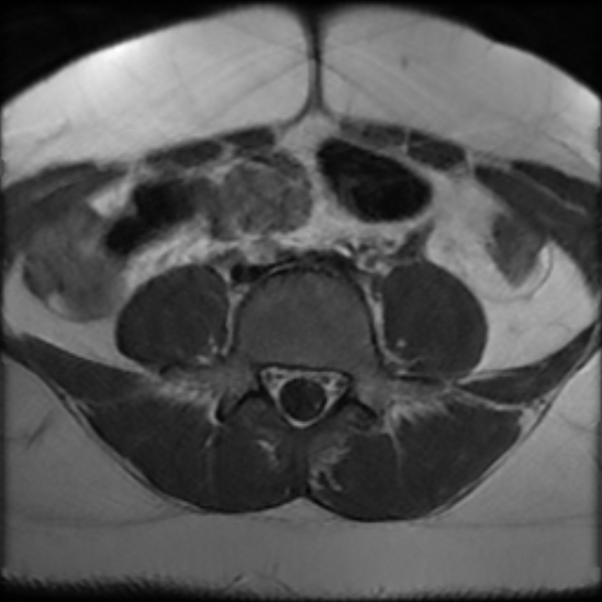 File:Bilateral ovarian fibrothecomas - adolescent (Radiopaedia 86604-102707 Axial T1 1).jpg