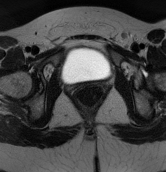 File:Bilateral ovarian fibrothecomas - adolescent (Radiopaedia 86604-102707 Axial T2 39).jpg