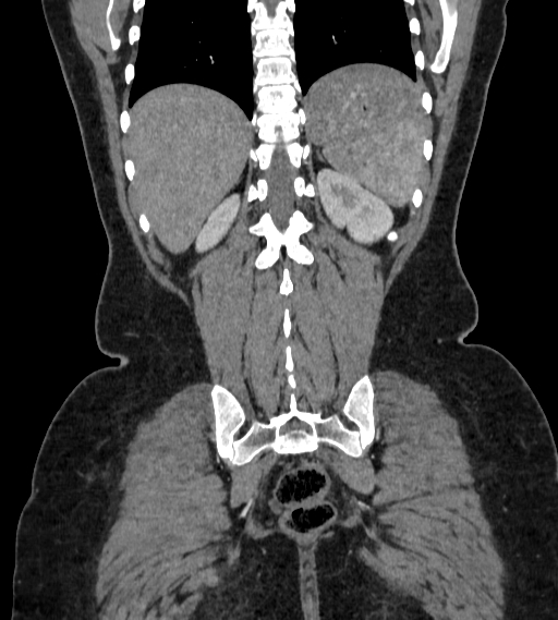 Bilateral ovarian mature cystic teratomas (Radiopaedia 79373-92457 B 83).jpg