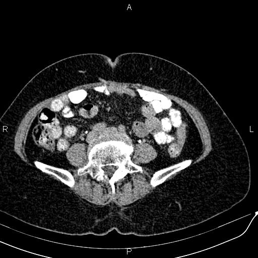 Bilateral ovarian serous cystadenocarcinoma (Radiopaedia 86062-101989 Axial C+ delayed 47).jpg