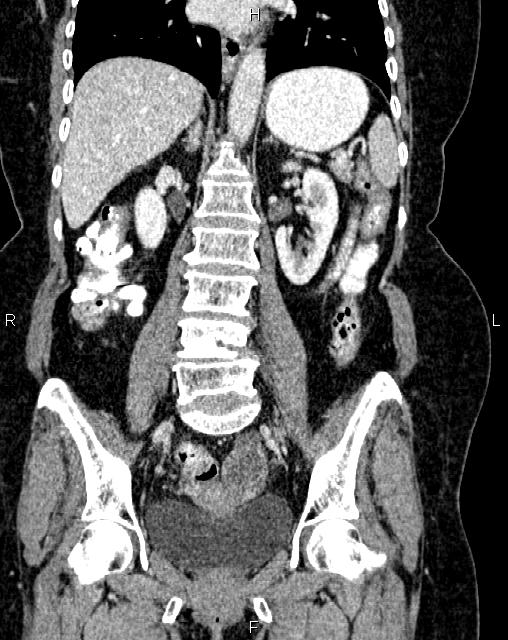 Bilateral ovarian serous cystadenocarcinoma (Radiopaedia 86062-101989 D 29).jpg