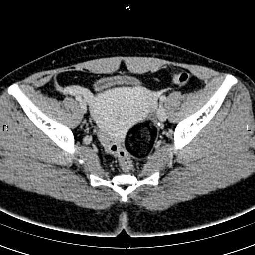 Bilateral ovarian teratoma (Radiopaedia 83131-97503 B 41).jpg
