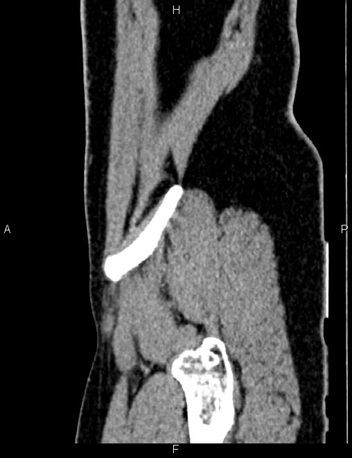 Bilateral ovarian teratoma (Radiopaedia 83131-97503 D 101).jpg
