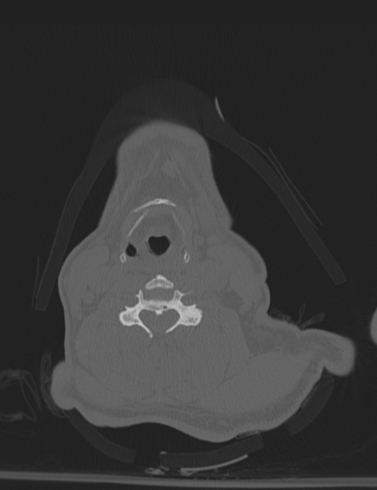 Bilateral perched facet joint (Radiopaedia 63149-71669 Axial bone window 34).jpg