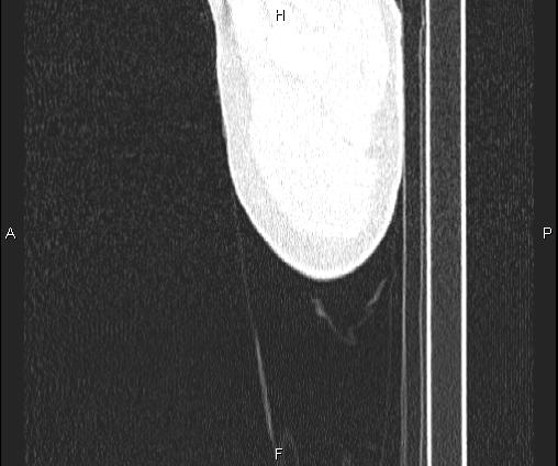 Bilateral pulmonary AVM (Radiopaedia 83134-97505 Sagittal lung window 3).jpg