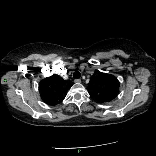 Bilateral pulmonary emboli (Radiopaedia 32700-33669 Axial C+ CTPA 13).jpg