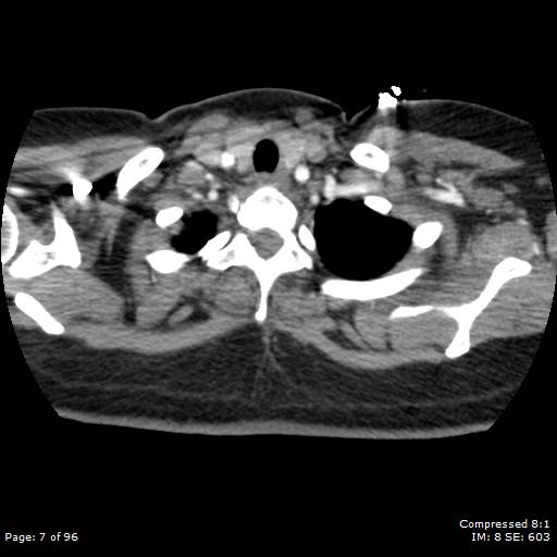 Bilateral pulmonary emboli with Hampton hump sign (Radiopaedia 54070-60246 Axial C+ CTPA 4).jpg