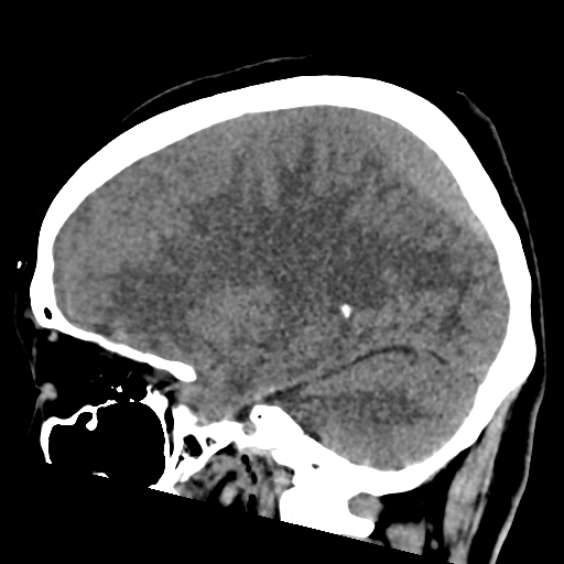 File:Bilateral subacute subdural hematoma (Radiopaedia 69240-79018 C 20).jpg