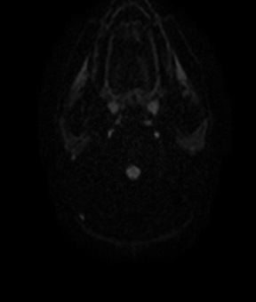 File:Bilateral thalamic gliomata (Radiopaedia 42538-45664 Axial DWI 1).jpg