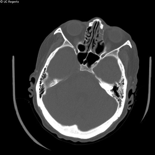 File:Bisphosphonate-related osteonecrosis of the maxilla (Radiopaedia 51367-57100 Axial bone window 16).jpg