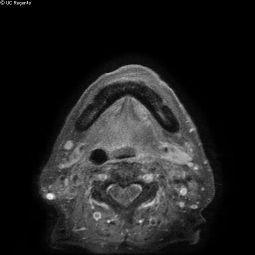 Bisphosphonate-related osteonecrosis of the maxilla (Radiopaedia 51367-57101 Axial T1 C+ fat sat 1).jpg