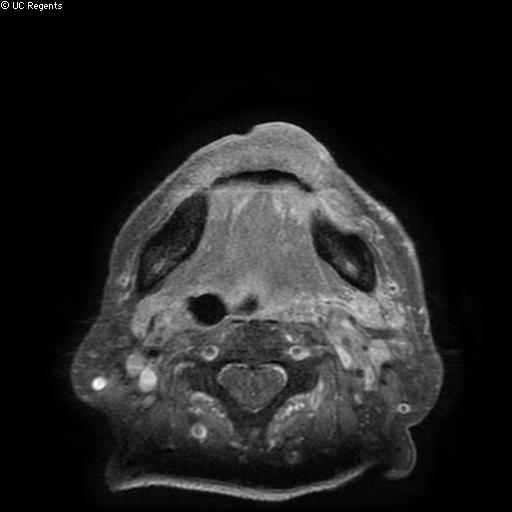 File:Bisphosphonate-related osteonecrosis of the maxilla (Radiopaedia 51367-57101 Axial T1 C+ fat sat 5).jpg