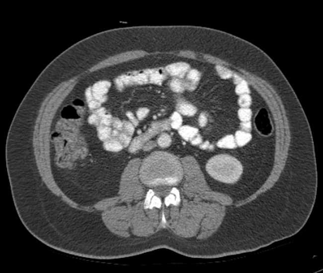 Bleeding duodenal ulcer and adenomyomatosis of gallbladder (Radiopaedia 61834-69861 A 66).jpg