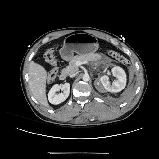 Blunt abdominal trauma with solid organ and musculoskelatal injury with active extravasation (Radiopaedia 68364-77895 A 49).jpg