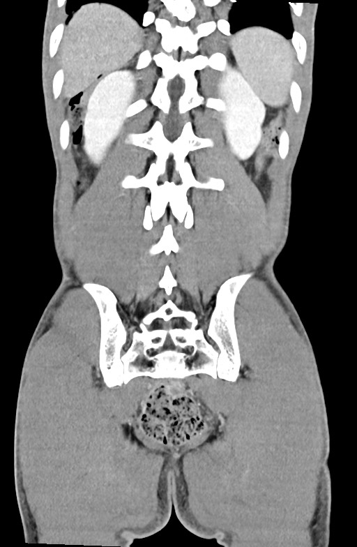 Blunt injury to the small bowel (Radiopaedia 74953-85987 B 78).jpg