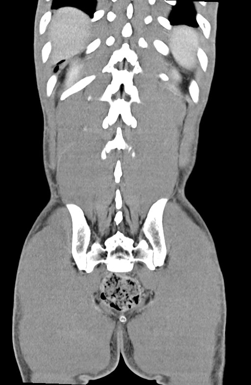 Blunt injury to the small bowel (Radiopaedia 74953-85987 B 81).jpg