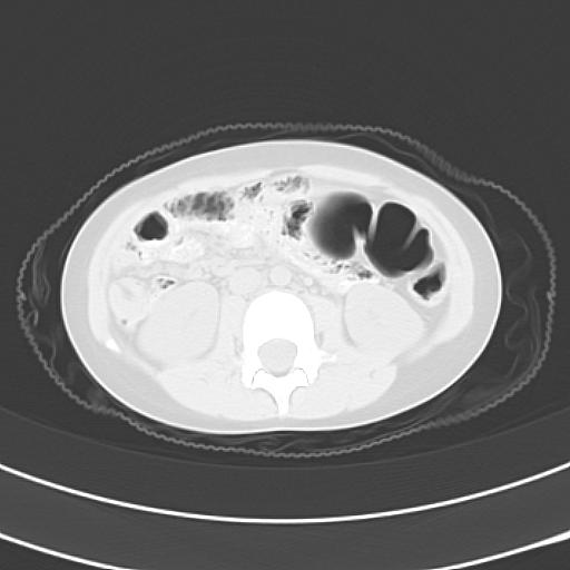 File:Bochdalek diaphragmatic hernia (Radiopaedia 38866-41059 Axial lung window 32).jpg