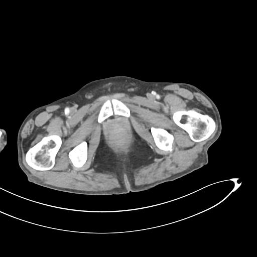 Bone metastasis from squamous cell carcinoma (Radiopaedia 30133-30730 B 81).jpg