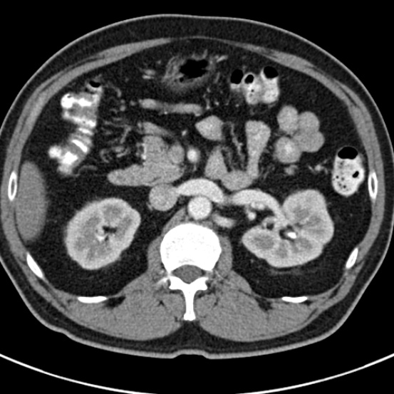 File:Bosniak cyst - type IV (Radiopaedia 23525-23627 renal cortical phase 19).jpg