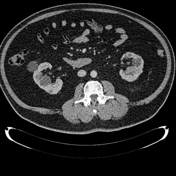 File:Bosniak renal cyst - type IV (Radiopaedia 24244-24518 C 185).jpg