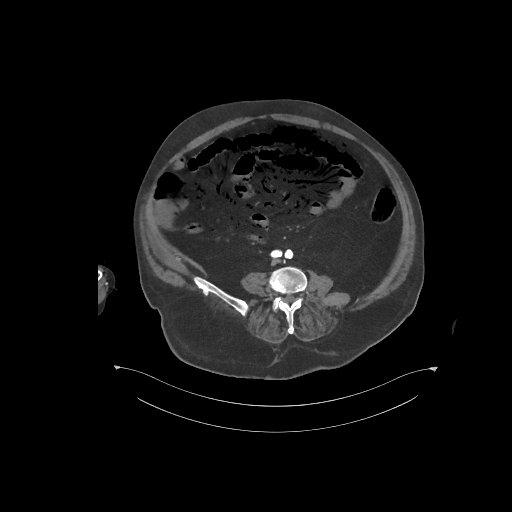 File:Bowel ischemia secondary to SMA occlusion with extensive portomesenteric venous gas (Radiopaedia 54656-60871 A 26).jpg