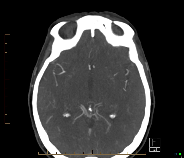 Brachiocephalic trunk stenosis (Radiopaedia 87242-103519 A 37).jpg