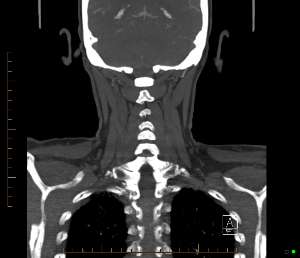 Brachiocephalic trunk stenosis (Radiopaedia 87242-103519 B 56).jpg