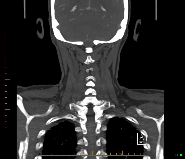Brachiocephalic trunk stenosis (Radiopaedia 87242-103519 B 57).jpg
