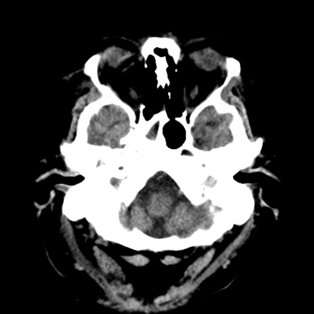 Brain cortical laminar necrosis (Radiopaedia 25822-25971 Axial non-contrast 5).jpg