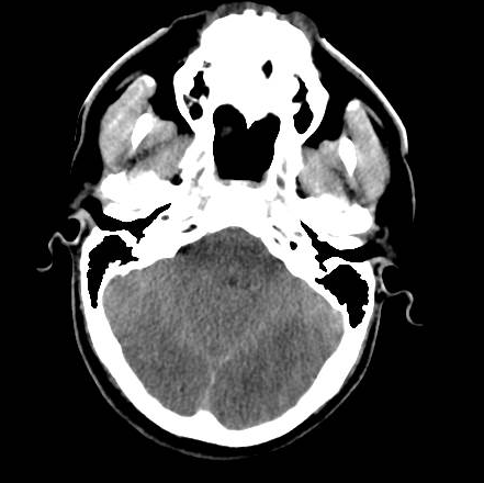 File:Brain death after motor vehicle collision (Radiopaedia 88470-105114 Axial 15).png