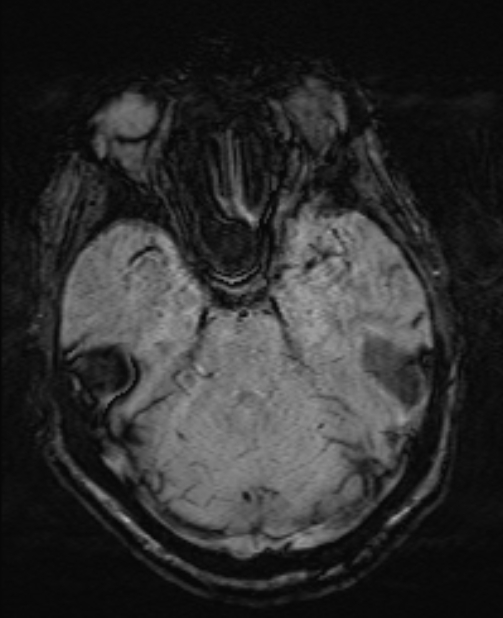 Brain metastases - lung cancer primary (Radiopaedia 75060-86115 Axial SWI 22).jpg