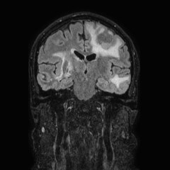 Brain metastases from lung cancer (Radiopaedia 83839-99028 Coronal FLAIR 41).jpg