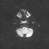 Brainstem glioma (Radiopaedia 67531-76922 Axial DWI 28).jpg