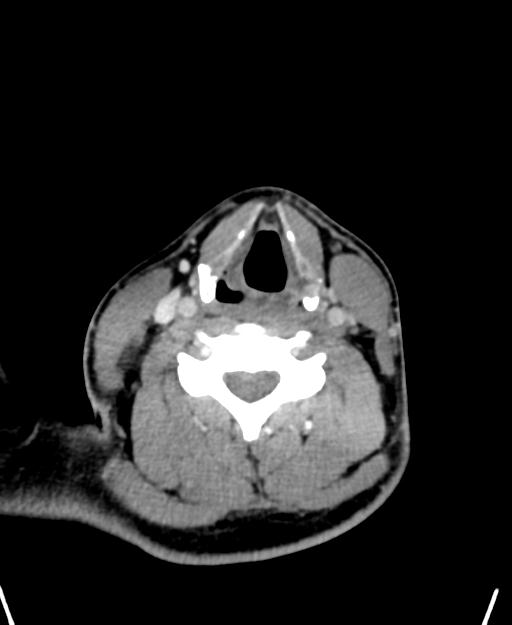 Branchial cleft cyst (Radiopaedia 31167-31875 Axial C+ delayed 39).jpg