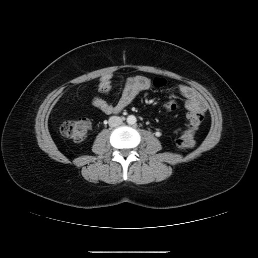 File:Breast cancer pseudocirrhosis after chemotherapy (Radiopaedia 65407-74456 Axial 40).jpg