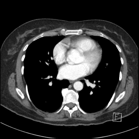 File:Breast metastases from renal cell cancer (Radiopaedia 79220-92225 A 55).jpg