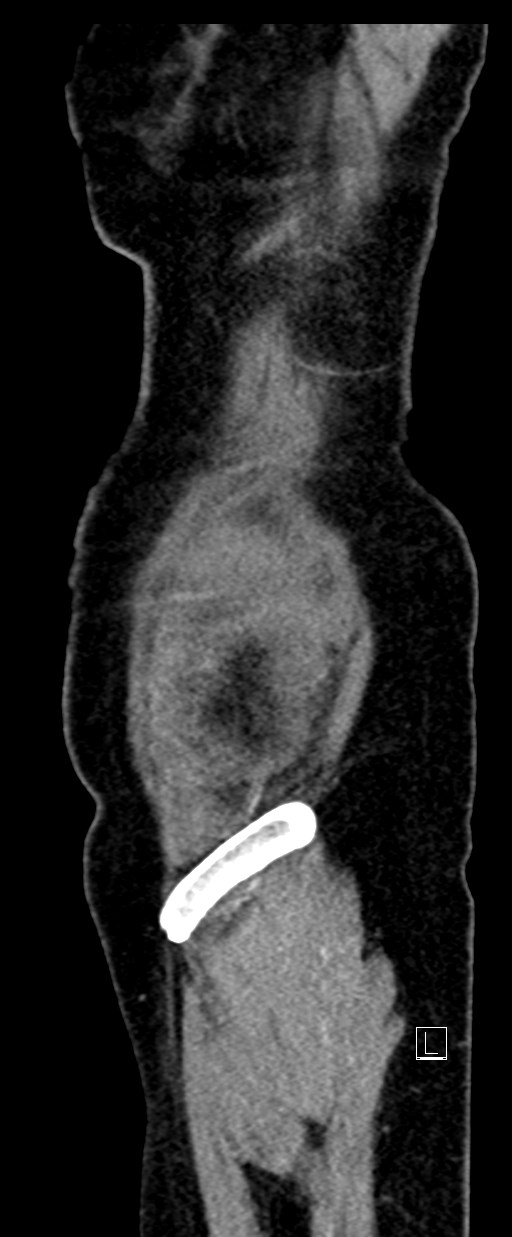Broad ligament hernia (Radiopaedia 84802-100276 C 81).jpg