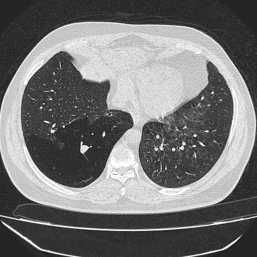 File:Bronchial atresia (Radiopaedia 58271-65417 Axial lung window 35).jpg