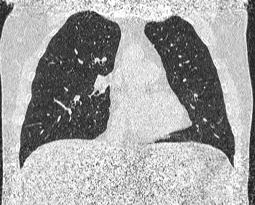 Bronchial atresia (Radiopaedia 58271-65417 Coronal lung window 22).jpg