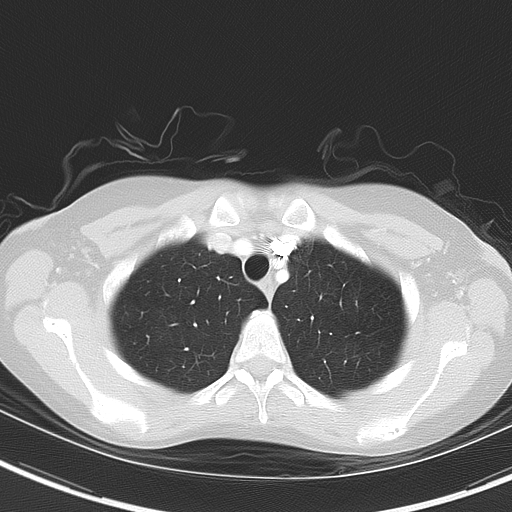 File:Bronchial atresia (Radiopaedia 73677-84470 Axial lung window 13).jpg