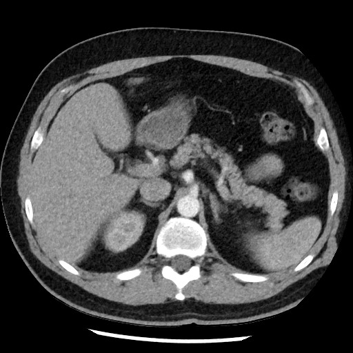 Bronchial carcinoid tumor (Radiopaedia 67377-76764 A 64).jpg