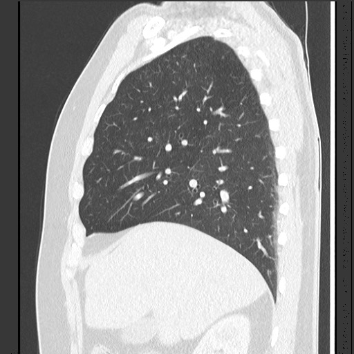 Bronchial carcinoid tumor (Radiopaedia 67377-76764 Sagittal lung window 21).jpg