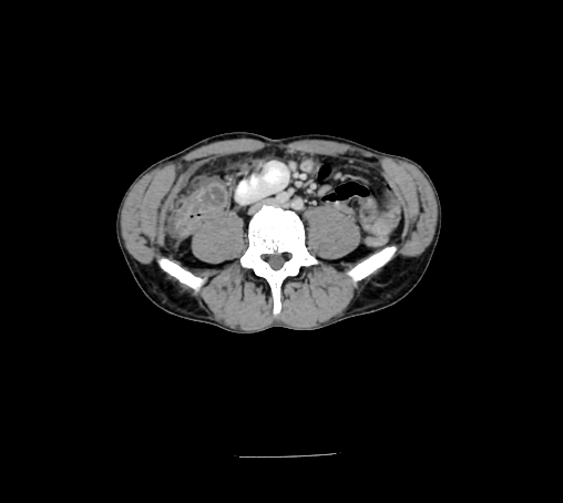 File:Bronchiectasis in Crohn disease (Radiopaedia 60311-67977 B 105).jpg