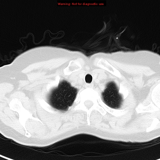 File:Bronchoalveolar carcinoma (BAC) (Radiopaedia 13436-13392 Axial lung window 4).jpg