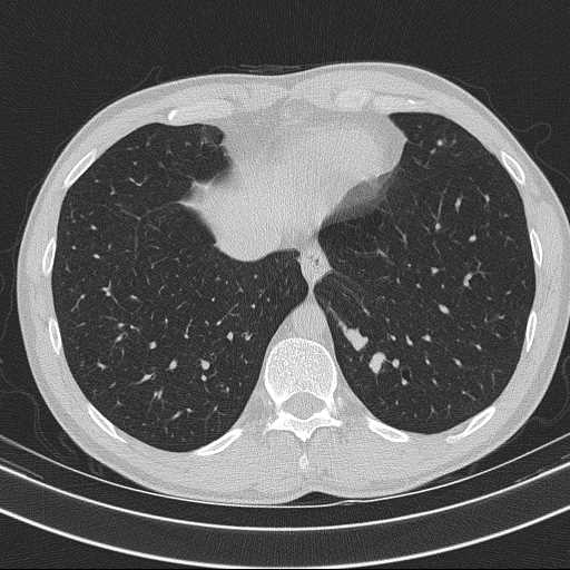 Bronchocele (Radiopaedia 60676-68429 Axial lung window 57).jpg