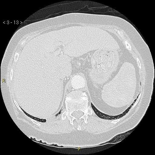 Bronchogenic carcinoma as an incidental finding (Radiopaedia 16453-16130 Axial lung window 13).jpg