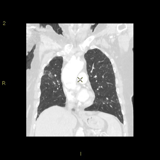 File:Bronchogenic carcinoma as an incidental finding (Radiopaedia 16453-16130 Coronal lung window 24).jpg