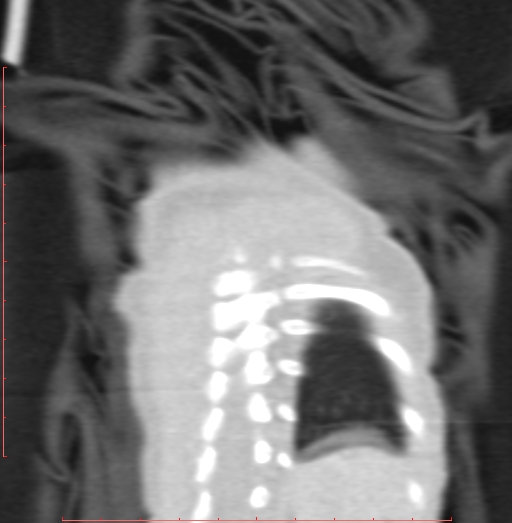 Bronchogenic cyst (Radiopaedia 78599-91409 Coronal lung window 210).jpg
