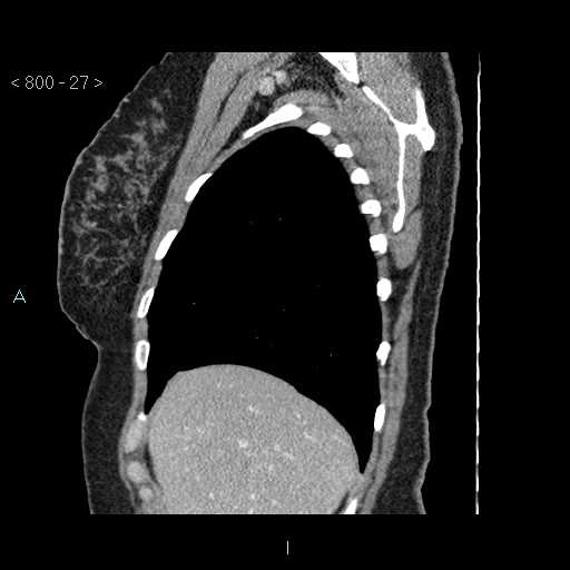 Bronchogenic cyst - posterior mediastinal (Radiopaedia 43885-47364 B 18).jpg